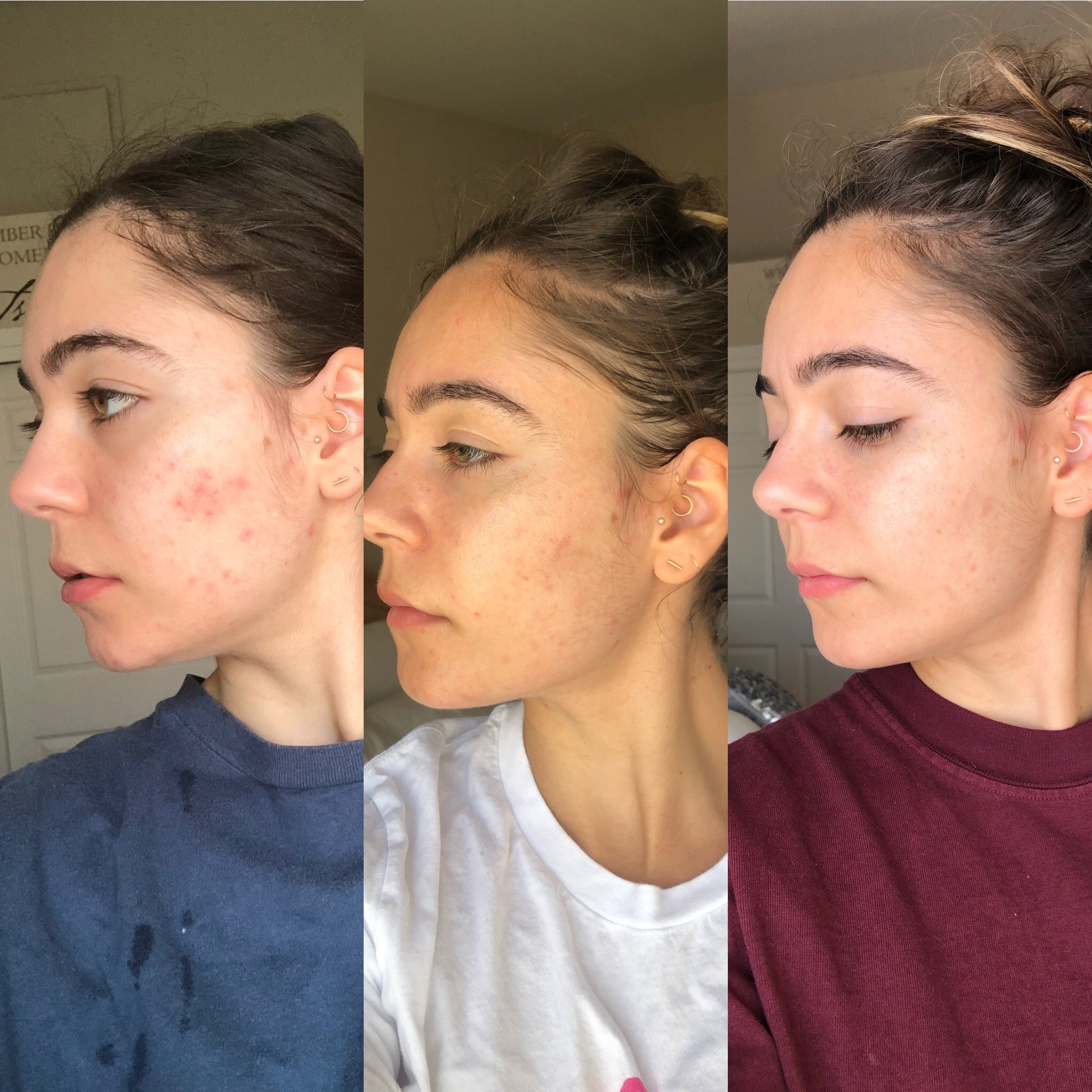 Bl+C (Siyah Kimyon + Cajeput) Sivilce Karşıtı Serum Konsantresi, 5 ml